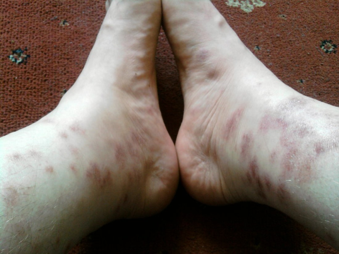 red spots on feet and ankles